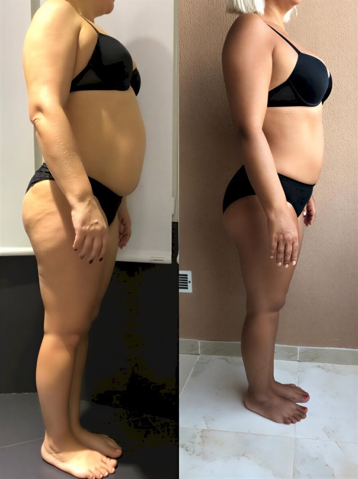 Resultados de lifting corporal completo antes y después en Istanbul Aesthetic Plastic Surgery Center