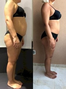 Результати до і після кругової підтяжки тіла в Istanbul Aesthetic Plastic Surgery Center