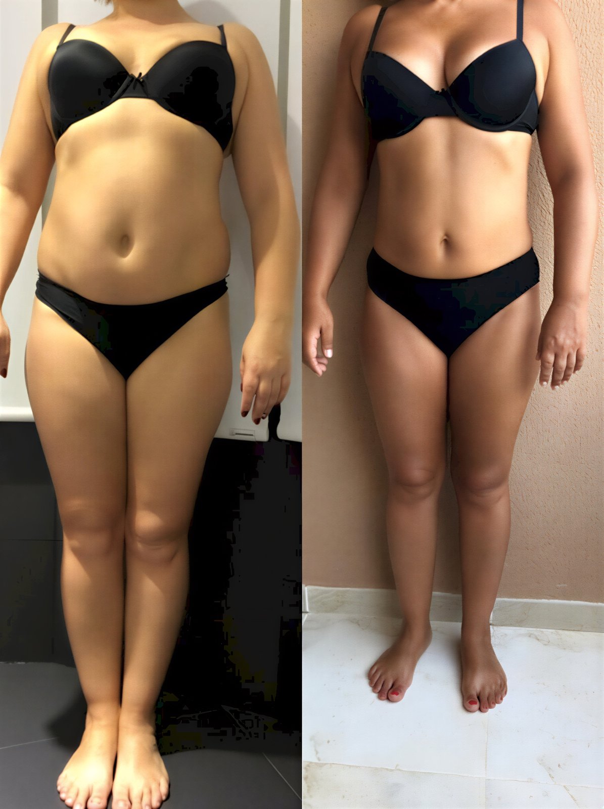 Resultados antes y después de body lift completo en Istanbul Aesthetic Plastic Surgery Center, contorno