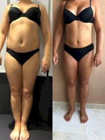 Результати до і після кругової підтяжки тіла в Istanbul Aesthetic Plastic Surgery Center, контур