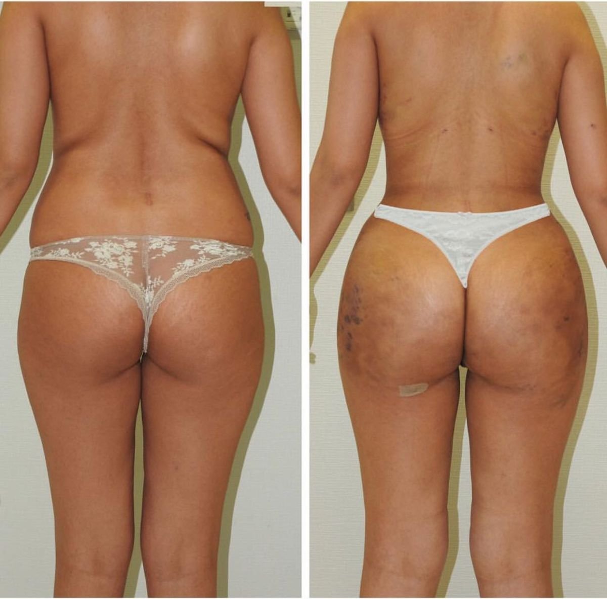 Resultados antes y después de full body lift en Istanbul Aesthetic Plastic Surgery Center, mejor contorno
