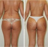 Результати до і після фул баді ліфтингу в Istanbul Aesthetic Plastic Surgery Center, покращений контур