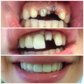 Dental implant before and after results at Istanbul Aesthetic Plastic Surgery Center, smile restored