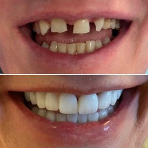 Resultados antes y después de implantes dentales en Istanbul Aesthetic Plastic Surgery Center, sonrisa restaurada