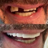 Resultados antes y después de implantes dentales en Istanbul Aesthetic Plastic Surgery Center, sonrisa restaurada