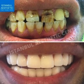 Resultados antes y después de coronas de zirconio en Istanbul Aesthetic Plastic Surgery Center