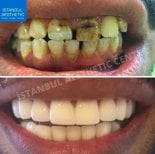 Resultados antes y después de coronas de zirconio en Istanbul Aesthetic Plastic Surgery Center