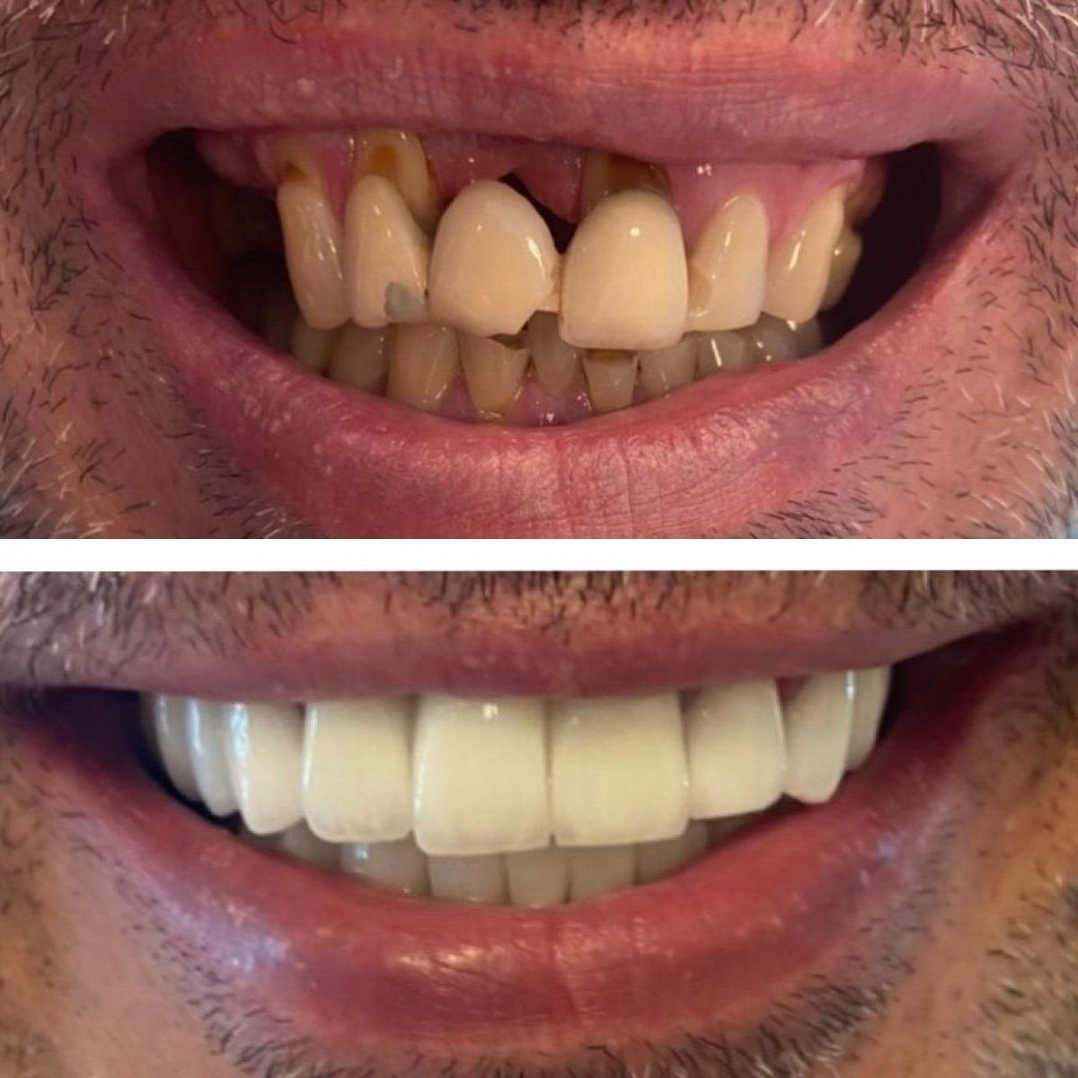 Resultados antes y después de coronas de zirconio en Istanbul Aesthetic Plastic Surgery Center