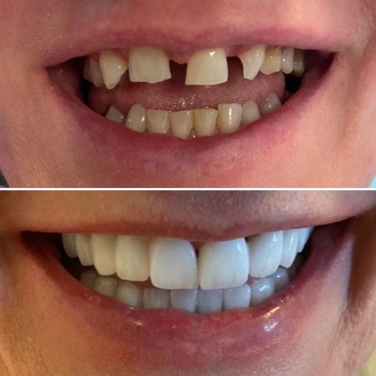 Resultados antes y después de coronas de zirconio en Istanbul Aesthetic Plastic Surgery Center