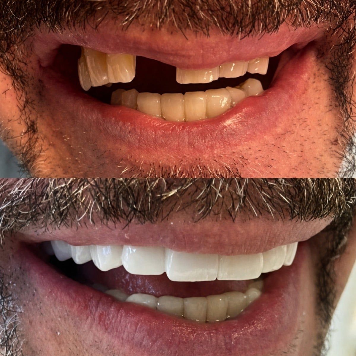 Resultados antes y después de coronas de zirconio en Istanbul Aesthetic Plastic Surgery Center