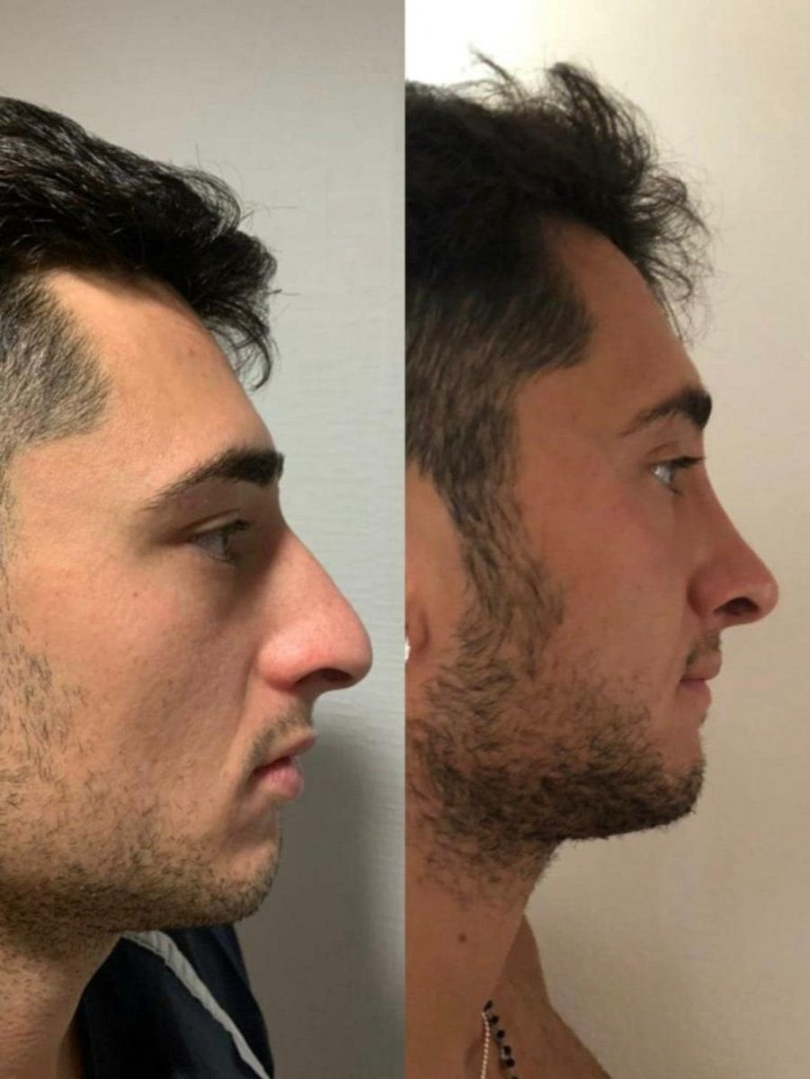 نتائج قبل وبعد عملية تجميل الأنف التصحيحية في مركز إسطنبول لجراحة التجميل