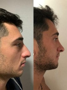 Resultados antes y después de rinoplastia secundaria en Istanbul Aesthetic Plastic Surgery Center