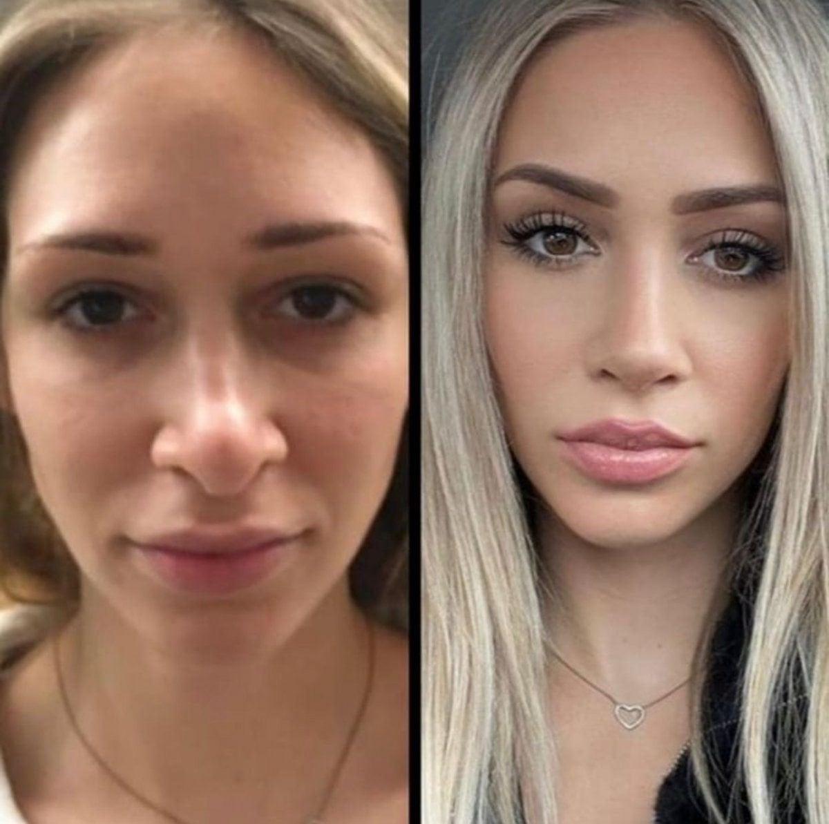 نتيجة قبل وبعد عملية تجميل الأنف التصحيحية في Istanbul Aesthetic Plastic Surgery Center