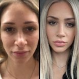 Resultado antes y después de rinoplastia secundaria en Istanbul Aesthetic Plastic Surgery Center