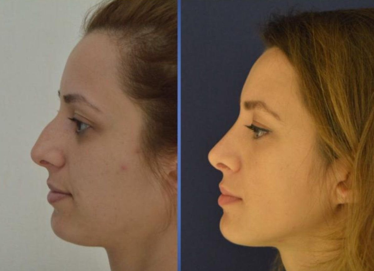 نتيجة قبل وبعد عملية تجميل الأنف التصحيحية في مركز إسطنبول لجراحة التجميل