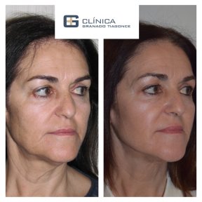 Before and after endoscopic facelift results at Clinica Granado Tiagonce, facial rejuvenation