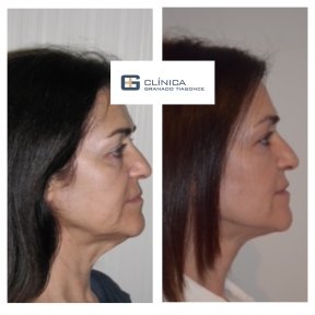 Before and after endoscopic facelift results at Clinica Granado Tiagonce, facial rejuvenation