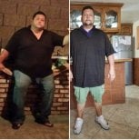 Before and after Gastric bypass photos by Dr. 