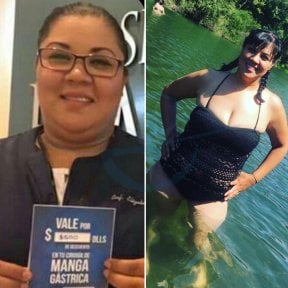 Before and after gastric balloon results at Hospital de la Familia, visible weight loss achieved