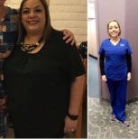 Before and after Gastric bypass photos by Dr. 