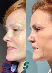 Upper and lower eyelid surgery before and after results at Soraca Med Istanbul, rejuvenated look