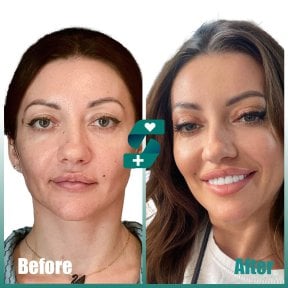 Before and after upper and lower eyelid surgery results at Soraca Med Istanbul, rejuvenated look