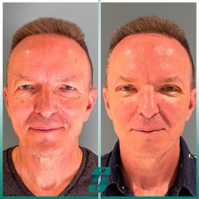 Before and after upper and lower eyelid surgery results at Soraca Med Istanbul, rejuvenated look