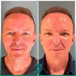 Before and after upper and lower eyelid surgery results at Soraca Med Istanbul, rejuvenated look