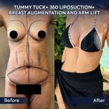 Dr.  тарапынан Емшек бездерінің липофилингі бұрын және кейін фотосуреттері