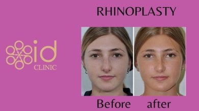 Before and after rhinoplasty results at ID Clinic Bangkok, nose reshaping with natural look