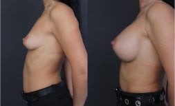Before and after breast lift results at Dr. MED – visible breast contour improvement