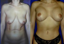 Before and after breast implants with lift results at Memorial Ataşehir Hospital, improved contour