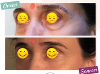 Vorher-nachher-Ergebnis der Blepharoplastik in Dunyagoz Eye Hospital Istanbul Etiler, Lidkorrektur