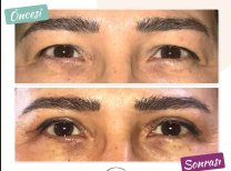 Blepharoplastik Vorher-Nachher-Ergebnis bei Dunyagoz Eye Hospital Istanbul Etiler, Lidkorrektur
