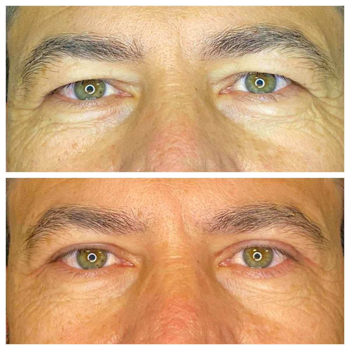 Resultados de blefaroplastia antes y después en Dunyagoz Eye Hospital Antalya, corrección de párpados