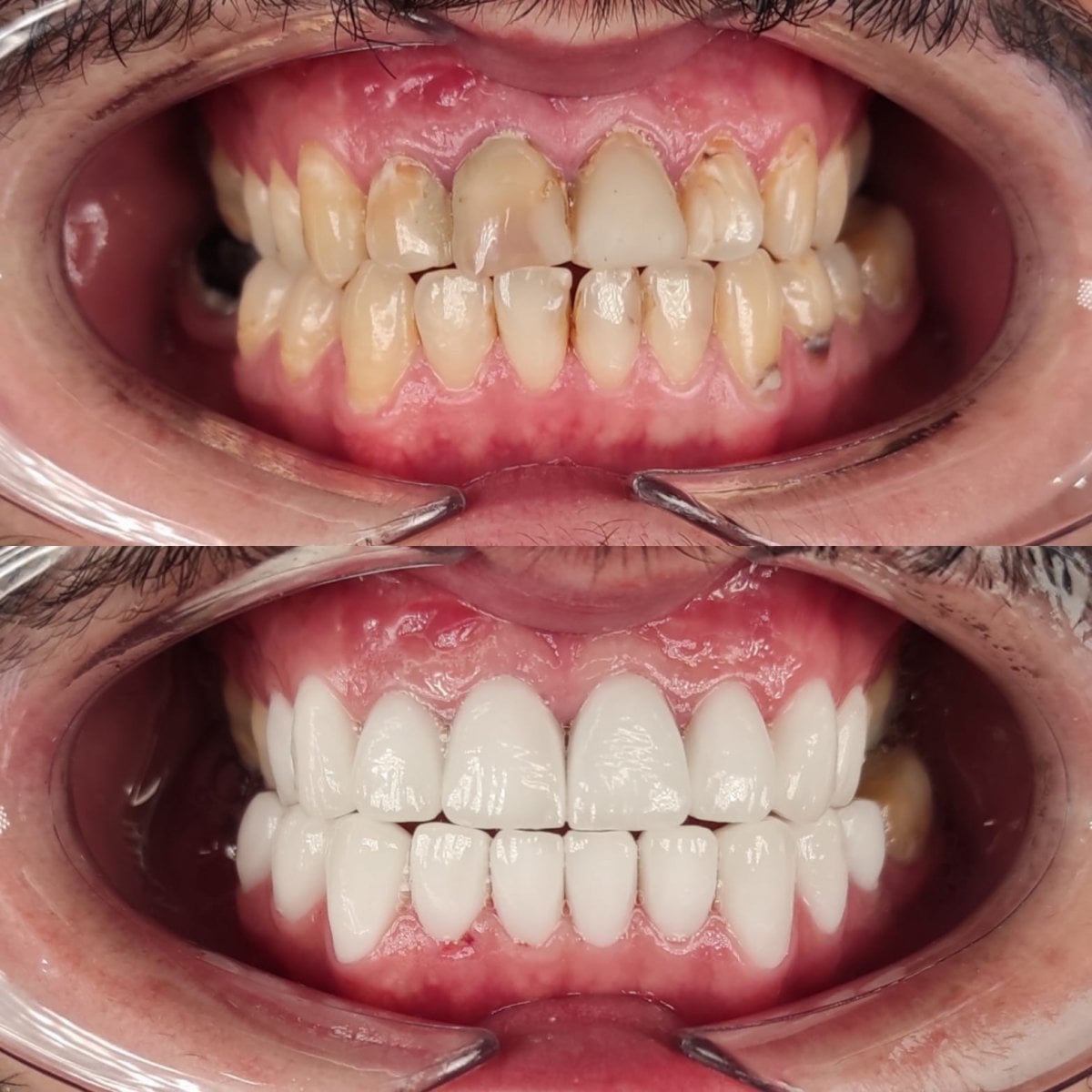 Resultados de restauración dental (bonding) antes y después en WestDent Clinic, sonrisa mejorada