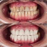 Результаты реставрации зубов (бондинг) до и после в WestDent Clinic, улучшенная улыбка
