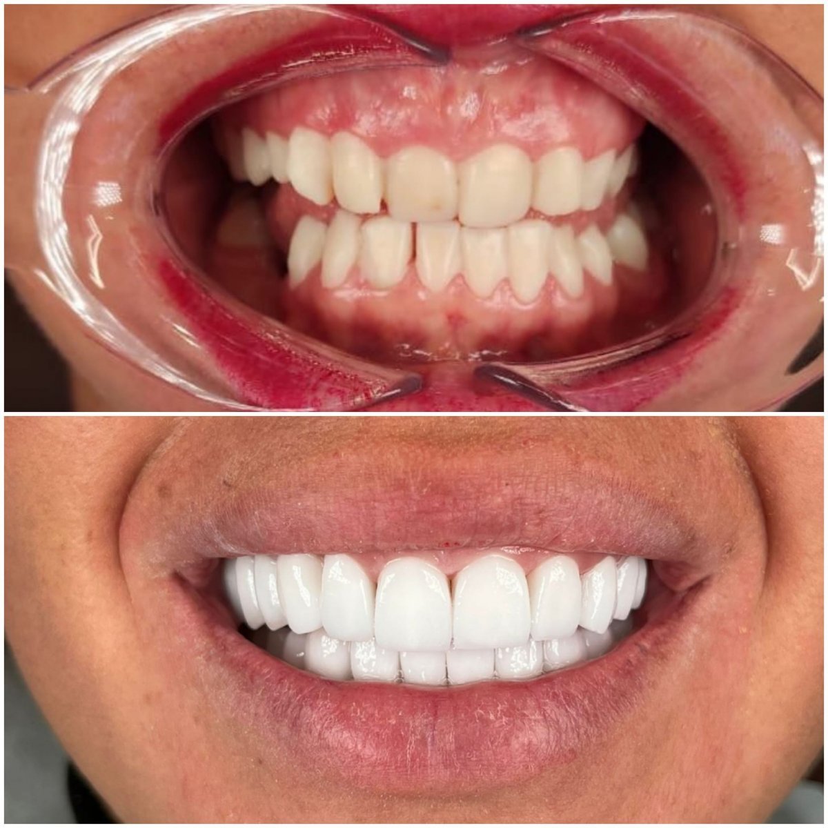 Resultados de restauración dental (bonding) antes y después en WestDent Clinic, sonrisa mejorada