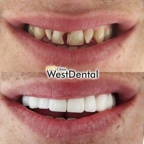 Resultados de restauración dental (bonding) antes y después en WestDent Clinic, sonrisa mejorada