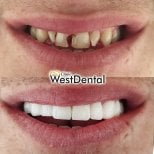 Resultados de restauración dental (bonding) antes y después en WestDent Clinic, sonrisa mejorada