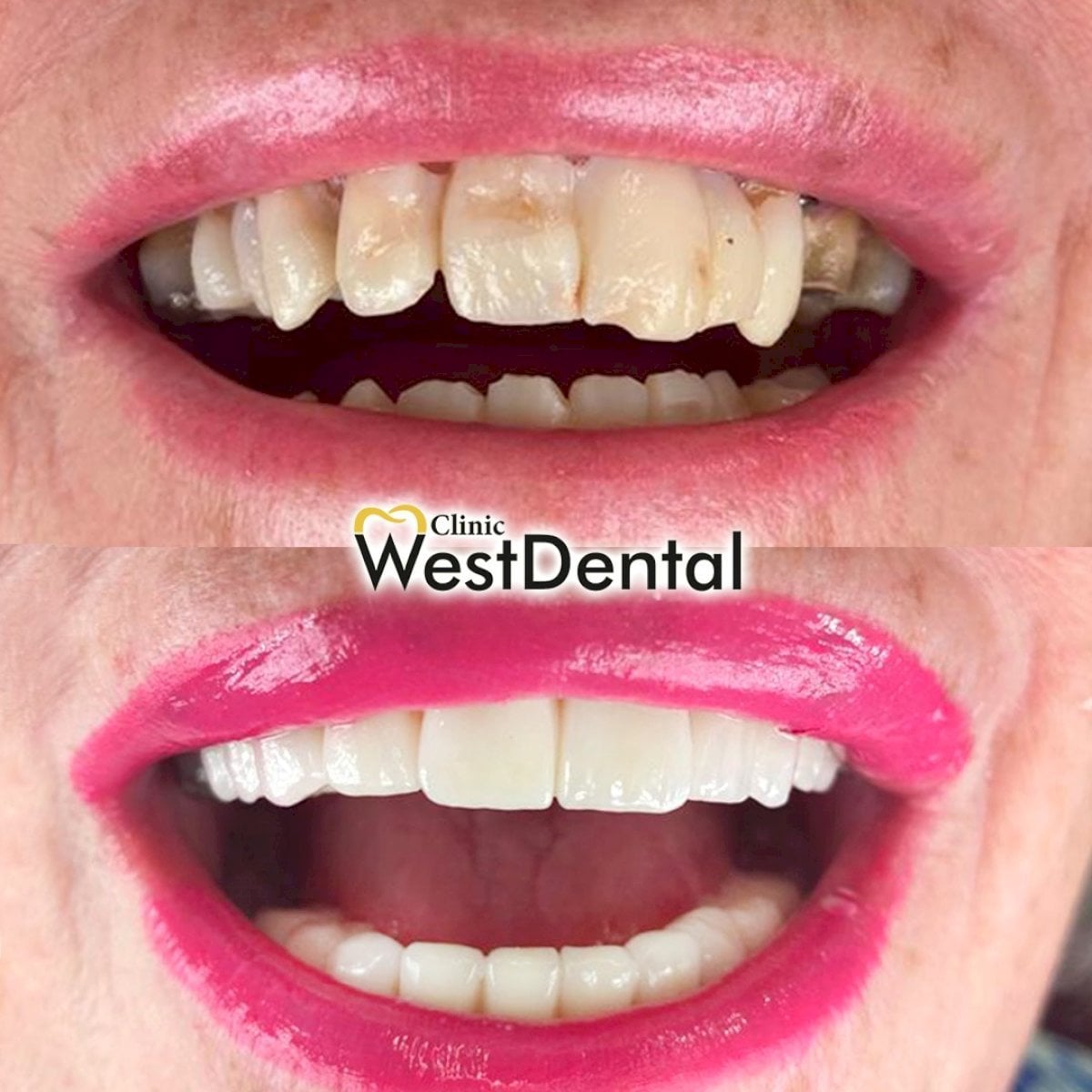 نتائج ترميم الأسنان (الترابط) قبل وبعد في WestDent Clinic، ابتسامة محسنة