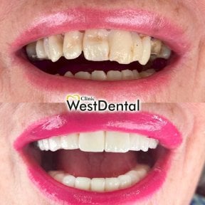 Resultados de restauración dental (bonding) antes y después en WestDent Clinic, sonrisa mejorada
