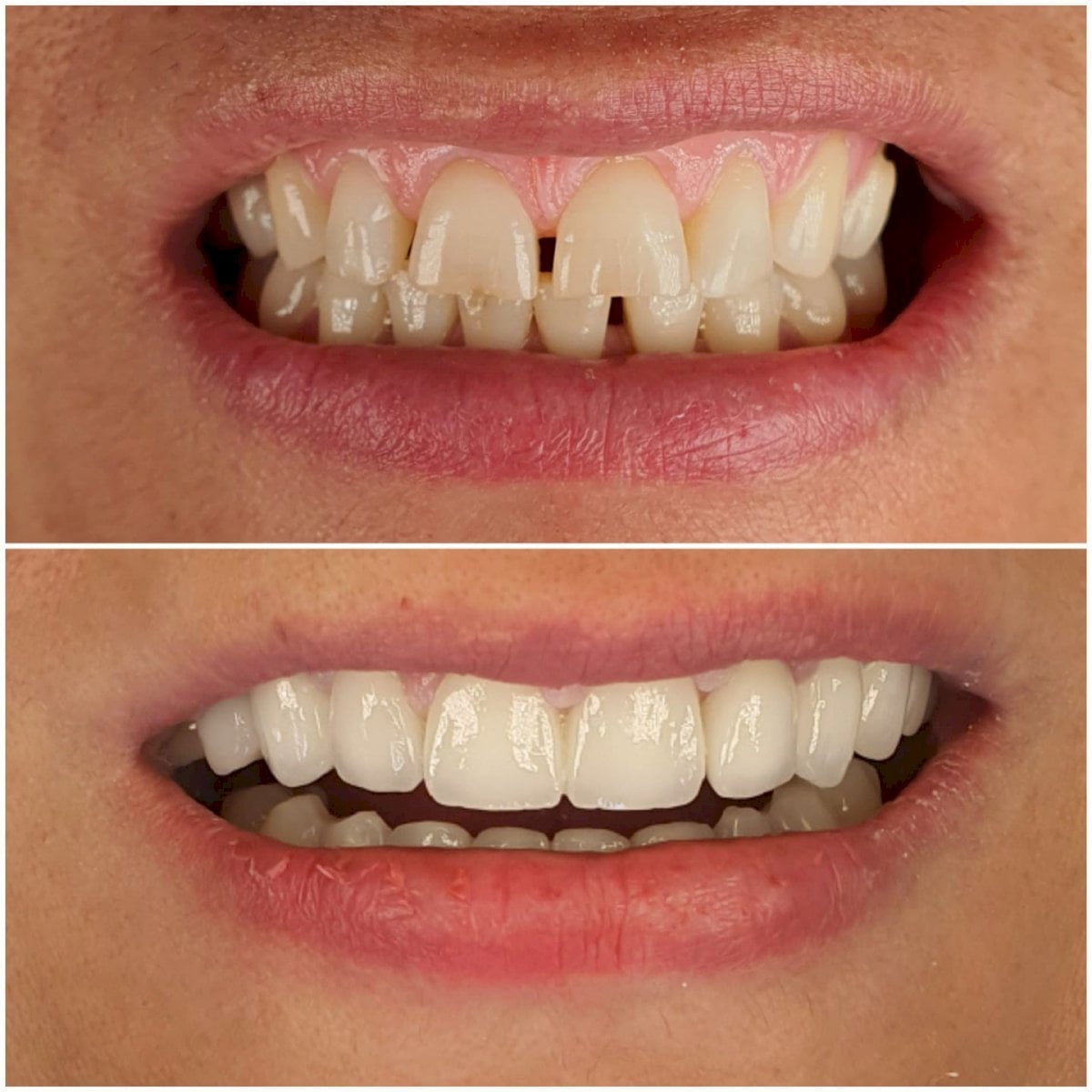 Antes y después de carillas Emax en WestDent Clinic: transformación natural de la sonrisa