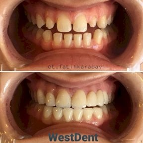 Before and after Emax veneers results at WestDent Clinic – smile makeover and aligned teeth