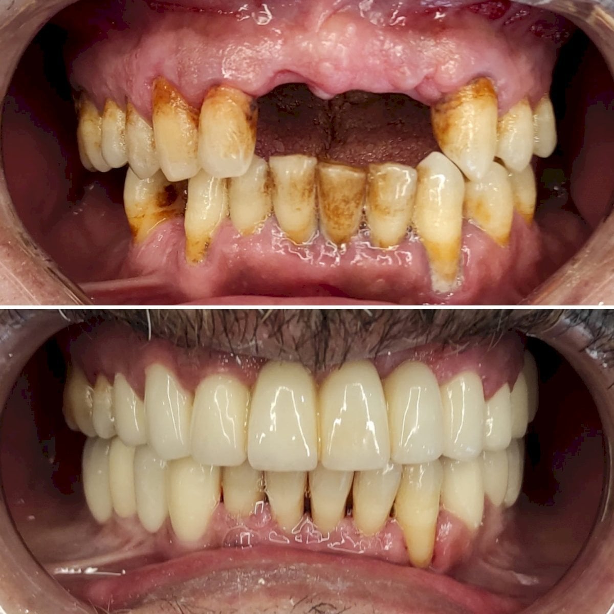 Antes y después de carillas Emax en WestDent Clinic: sonrisa renovada y dientes más blancos