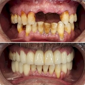 Before and after Emax veneers at WestDent Clinic – smile makeover and whiter teeth result
