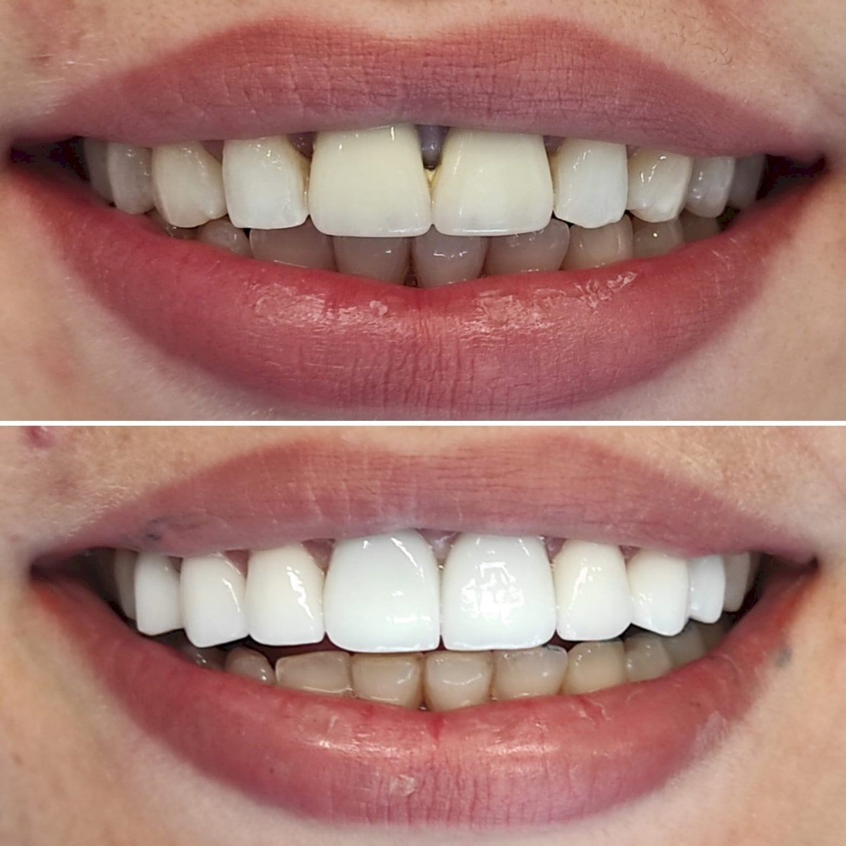 نتيجة قبل وبعد عدسات إيماكس في عيادة WestDent – ابتسامة طبيعية محسنة