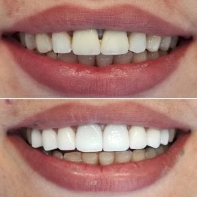 Before and after Emax veneers result at WestDent Clinic – smile makeover with natural look