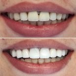 Before and after Emax veneers result at WestDent Clinic – smile makeover with natural look