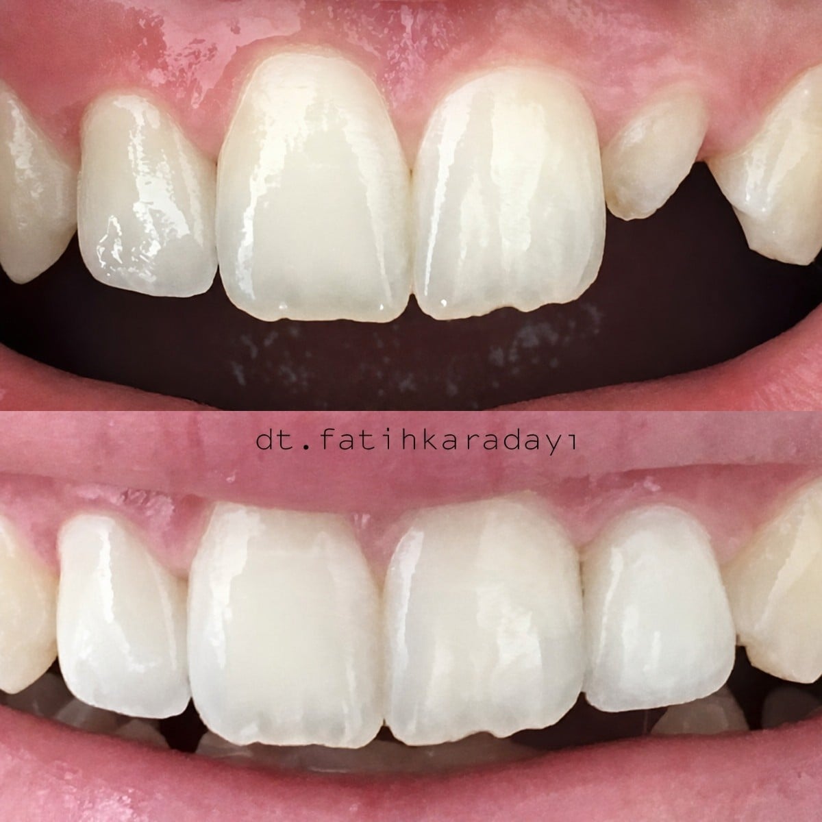 نتائج قبل وبعد فينير إيماكس في WestDent Clinic – تحسين شكل ولون الأسنان